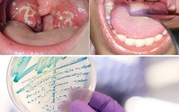 ما لا تعرفونه عن وباء الدفتيريا الذي قتل حالتين بالمغرب ورصدت الوزارة الوصية بؤرته جنوب المملكة